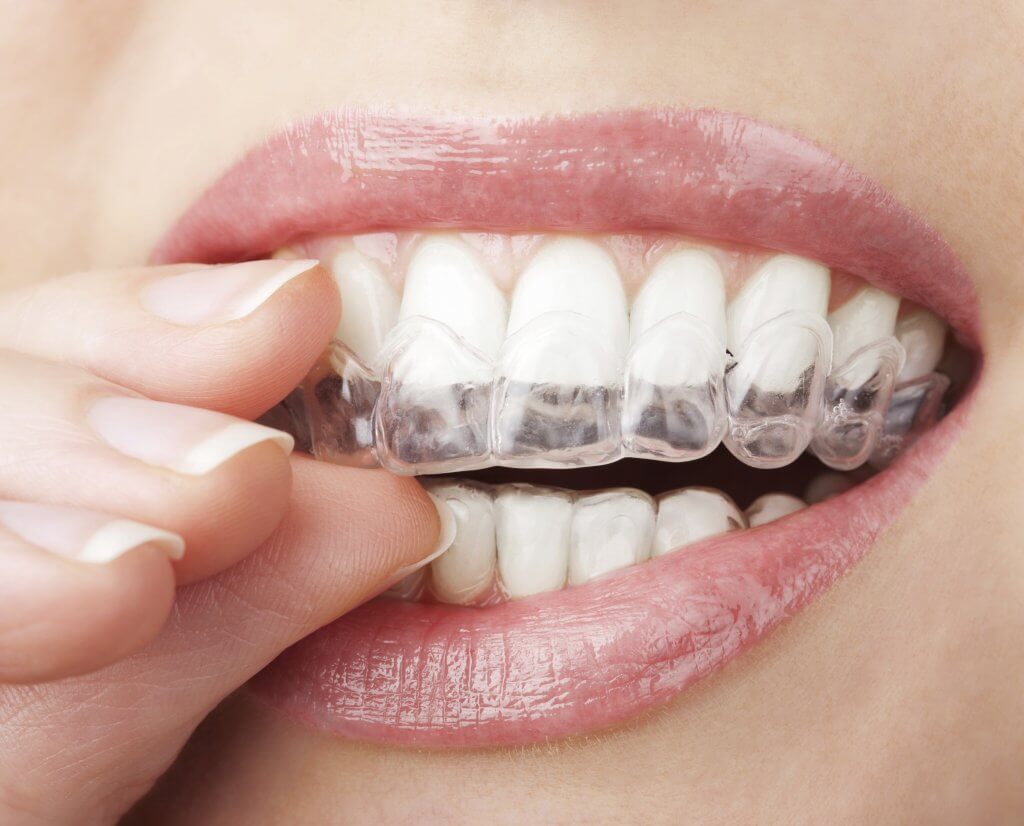 tmj occlusal splints dental therapy teeth